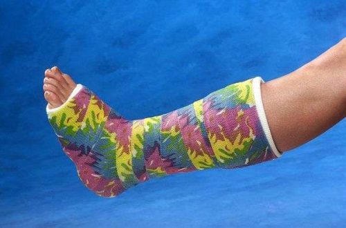 Delta-Cast Elite műanyag gipsz 10cm x 3,6m poliészter több színben